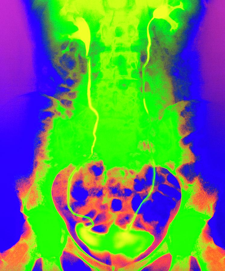 Colour X-ray Of Healthy Kidneys Photograph by Science Photo Library