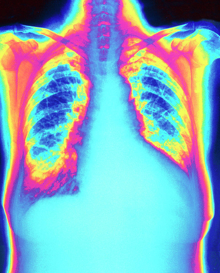 Colour X-ray Of Heart Showing Ventricular Failure Photograph by Science ...