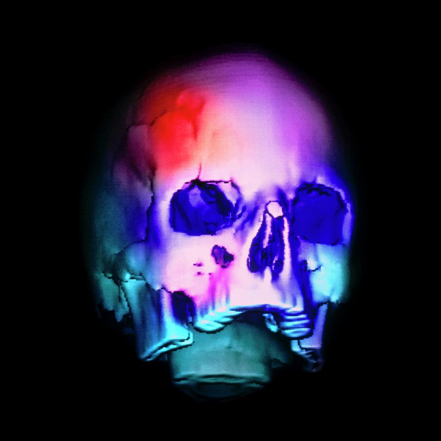 skull fracture