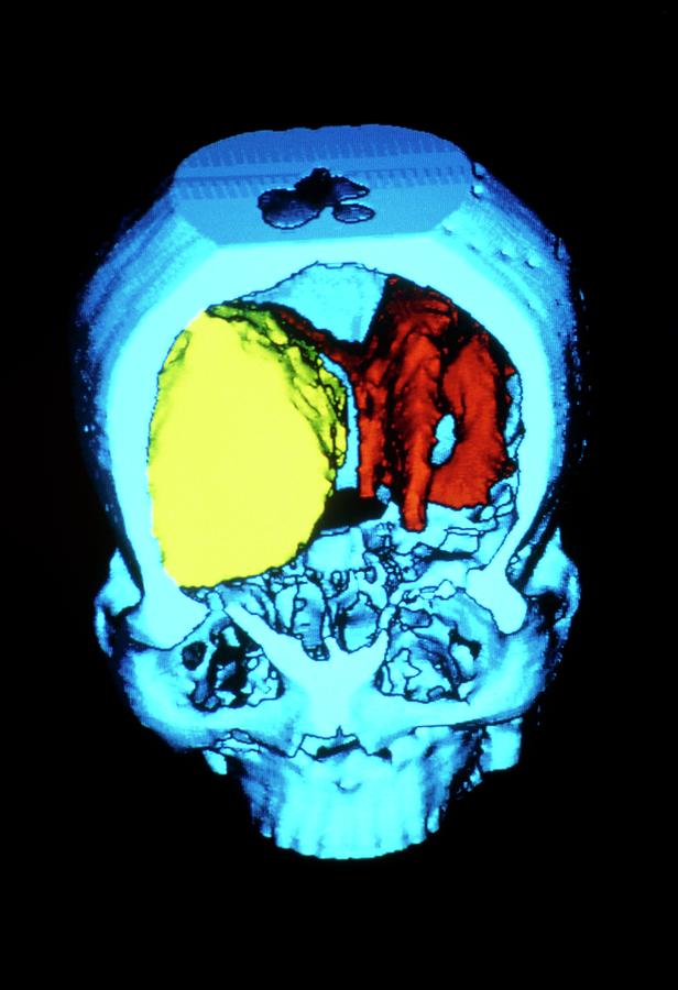 Coloured 3-d Ct Scan Of Brain With Meningioma Photograph by Cnri/science Photo Library