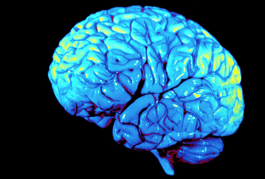 Coloured 3-d Mri Scan Of Brain Seen From The Side Photograph by Gjlp/science Photo Library