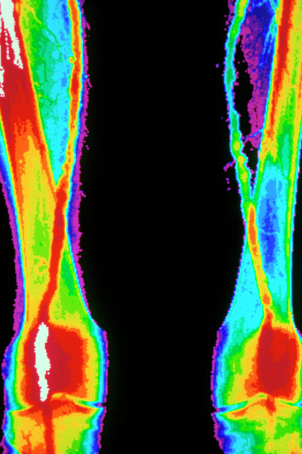 Coloured Angiogram Of Arteries In The Legs Photograph by Gca/science Photo Library