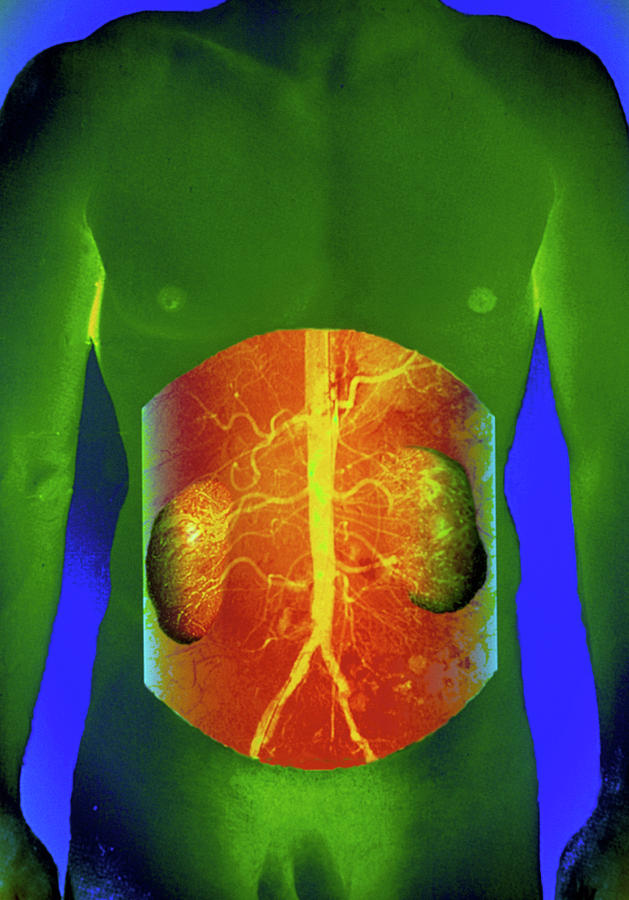 Coloured Angiogram Of Blood Supply To The Kidneys Photograph by Gjlp/science Photo Library