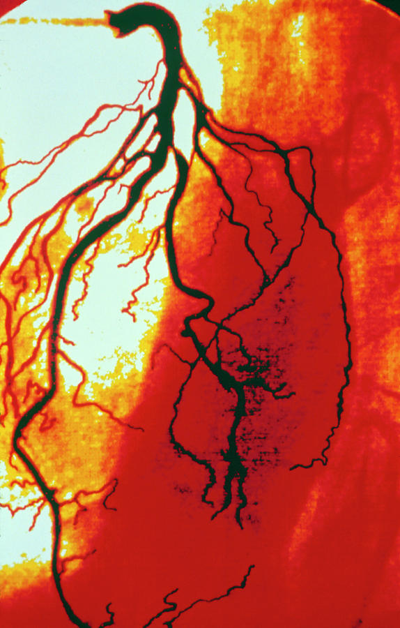 Coloured Angiogram Of Coronary Artery Of The Heart Photograph by Cnri/science Photo Library