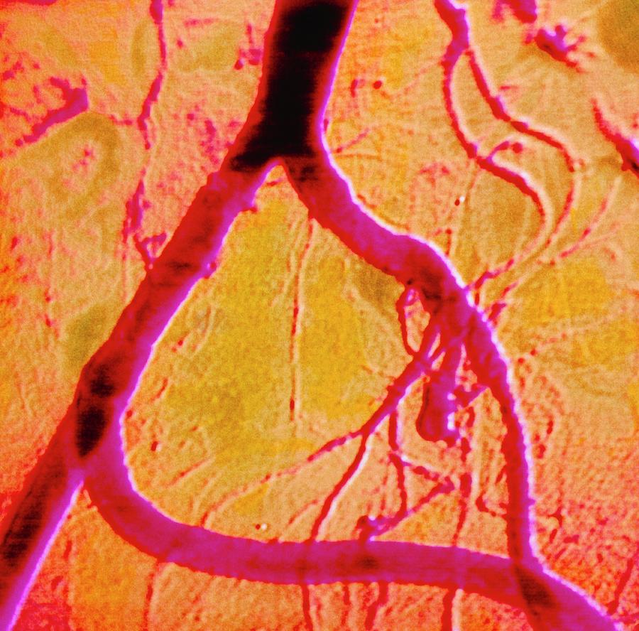 Coloured Angiogram Of Iliac Artery Bypass Photograph by Cnri/science Photo Library