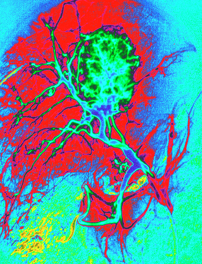 Liver Cancer Photograph - Coloured Angiogram X-ray Of A Tumour In The Liver by Mehau Kulyk/science Photo Library Liver Cancer Photograph - Coloured Angiogram X-ray Of A Tumour In The Liver by Mehau Kulyk/science Photo Library