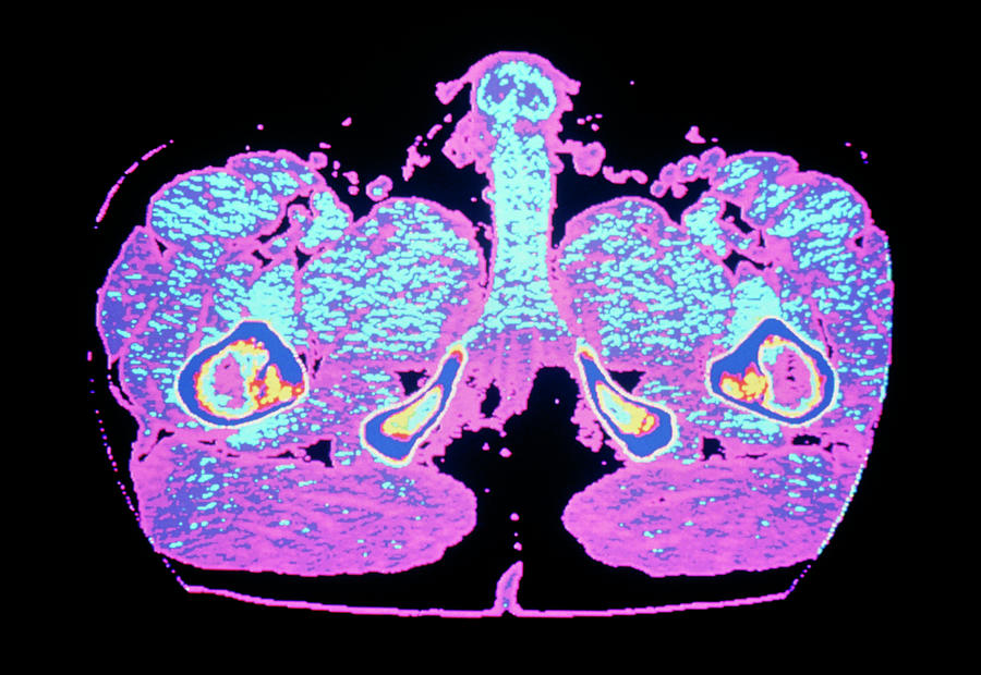 Thigh Photograph - Coloured Computed Tomography Scan Of Erect Penis by Cnri/science Photo Library