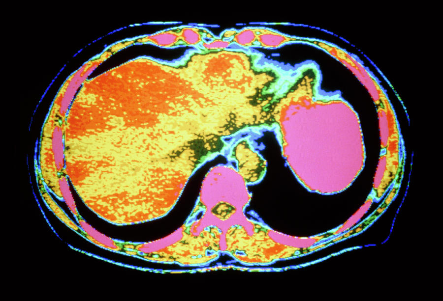 Coloured Ct Scan Of Abdomen With Liver & Stomach by Science Photo Library