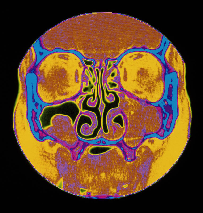 nasal-polyp-ct-scan