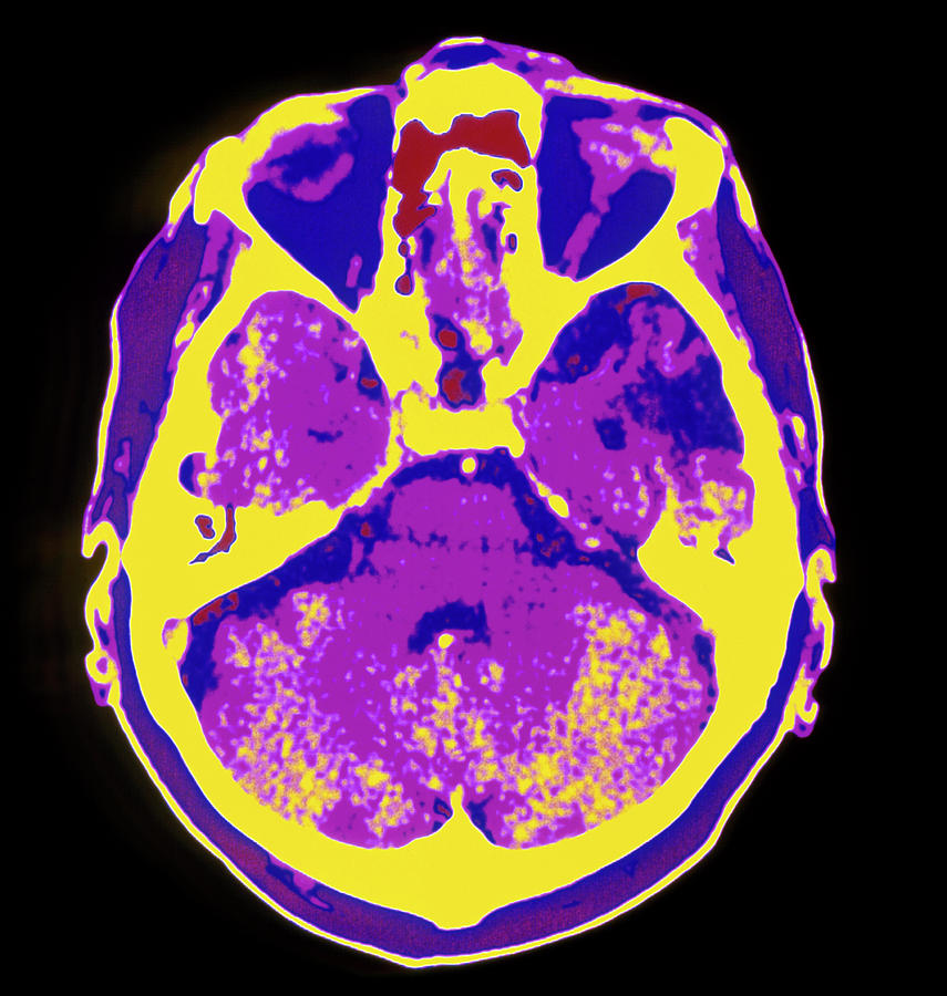 Coloured Ct Scan Of The Brain Showing A Stroke Photograph by Mehau ...