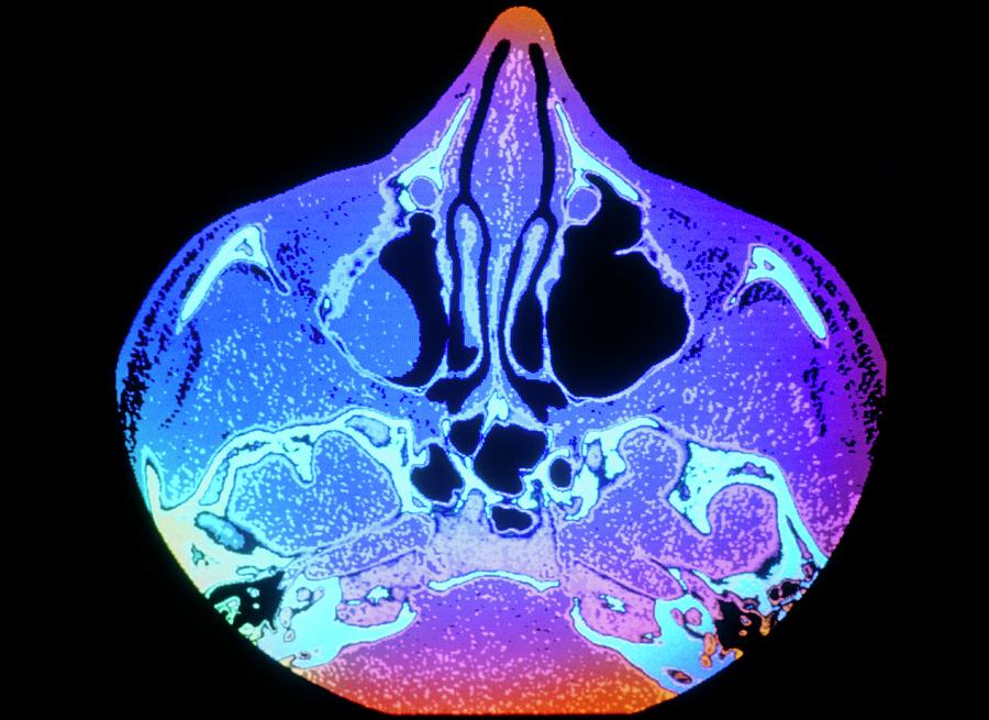 Nasal Polyp Ct Scan