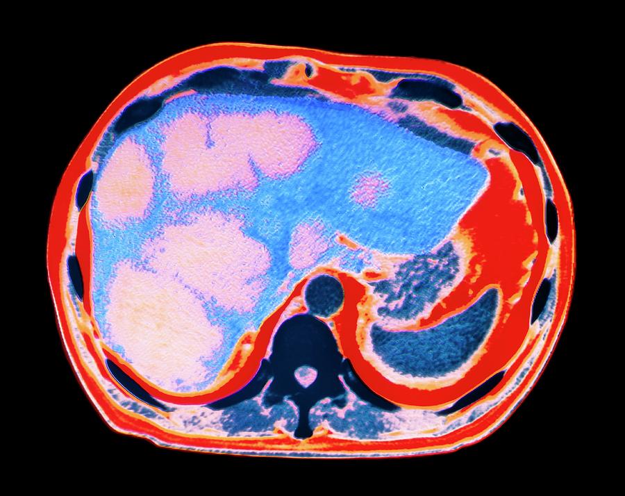 Coloured Ct Scan Showing Cancer Of The Liver Photograph by Dept. Of ...