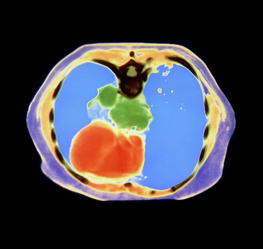 Coloured Ct Scan Showing Cancer Of The Oesophagus Photograph by Dept ...