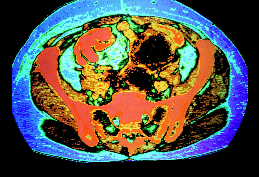 Coloured Ct Scan Showing Cancer Of Uterus & Ovary Photograph by Gca ...