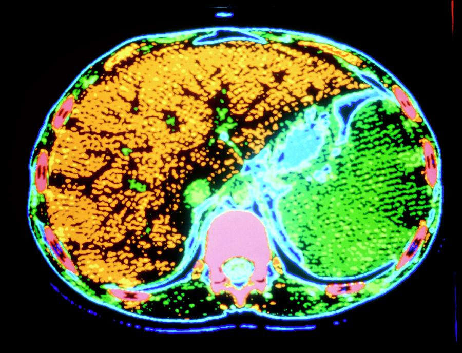 Coloured Ct Scan Showing Enlarged Spleen Photograph by Cnri/science ...