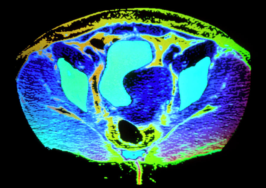 Coloured Ct Scan Showing Uterus Wihth A Fibroid Photograph By Gjlp 