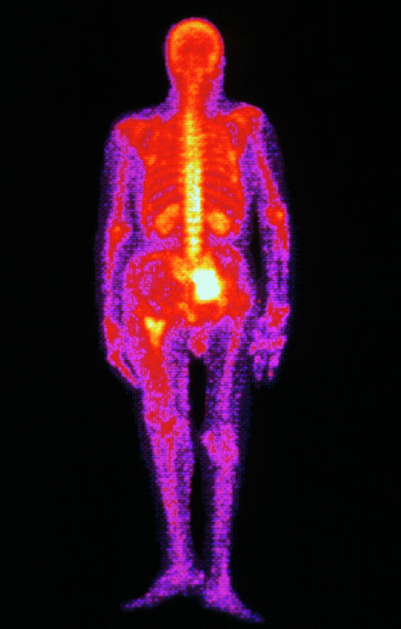 Coloured Gamma Scan Of Metastatic Thyroid Cancer