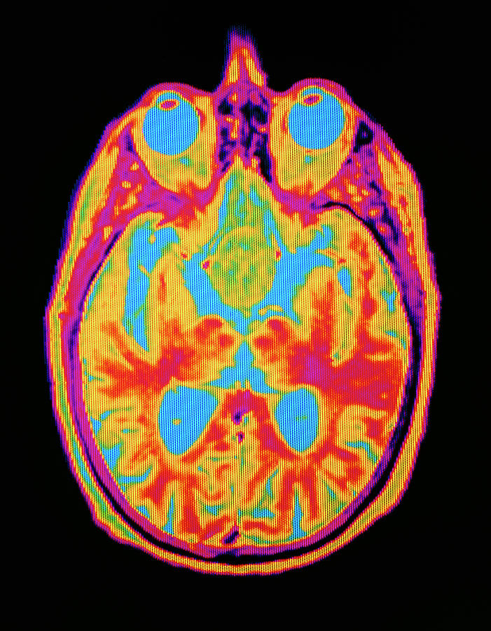 Coloured Mri Brain Scan: Pituitary Adenoma Photograph by Mehau Kulyk ...