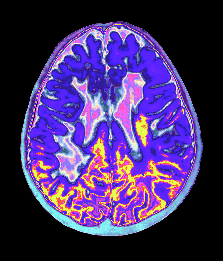 Coloured Mri Brain Scan Showing Multiple Sclerosis Photograph by Mehau Kulyk/science Photo Library