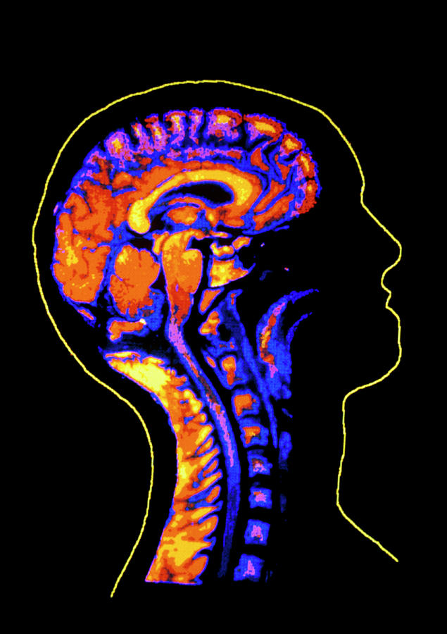 Coloured Mri Brain Scan (side View) Photograph by Gca/science Photo Library