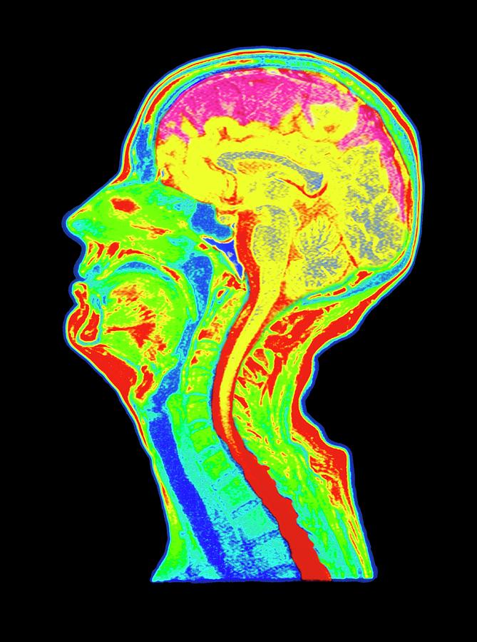 Coloured Mri Scan Of A Brain With Cerebral Atrophy Photograph by Simon ...