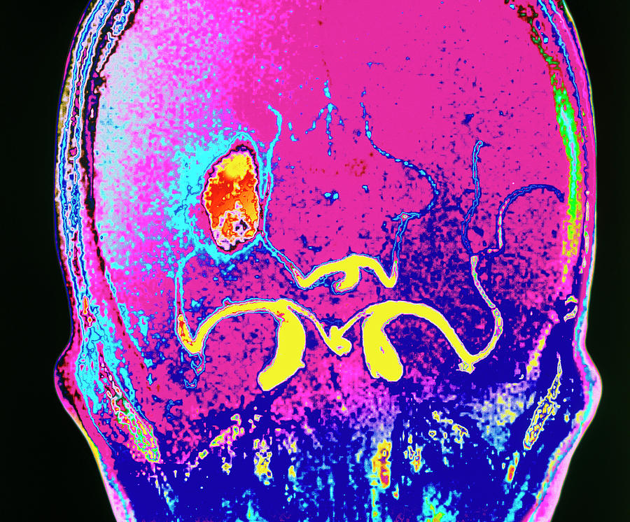 Coloured Mri Scan Of A Cerebral Infarction Photograph By Simon Fraser