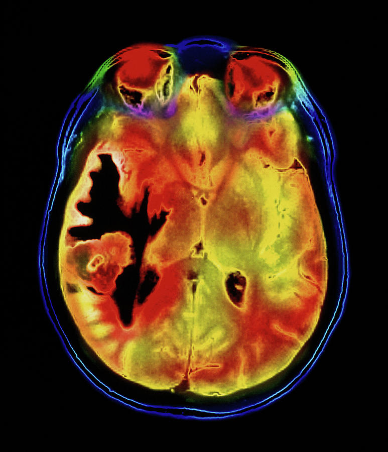 Coloured Mri Scan Of A Metastatic Brain Tumour Photograph by Simon ...