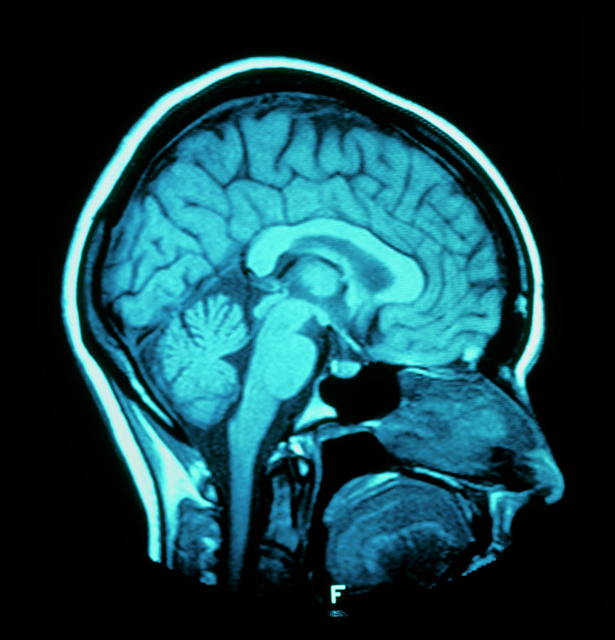 Sagittal Brain Mri