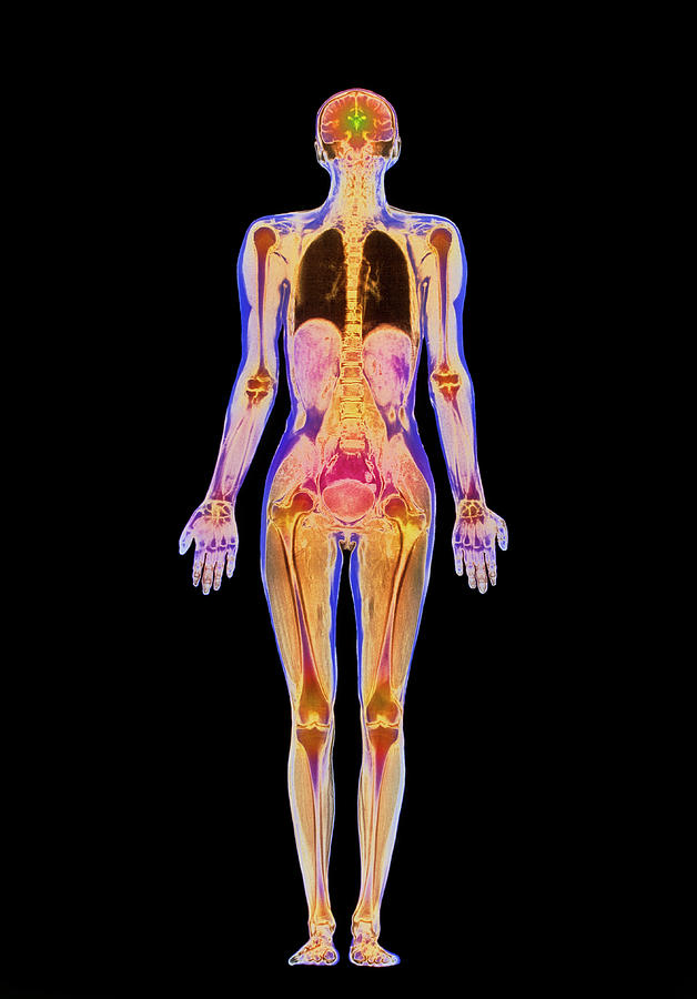 Whole Body Photograph - Coloured Mri Scan Of A Whole Human Body (female) by Simon Fraser/science Photo Library