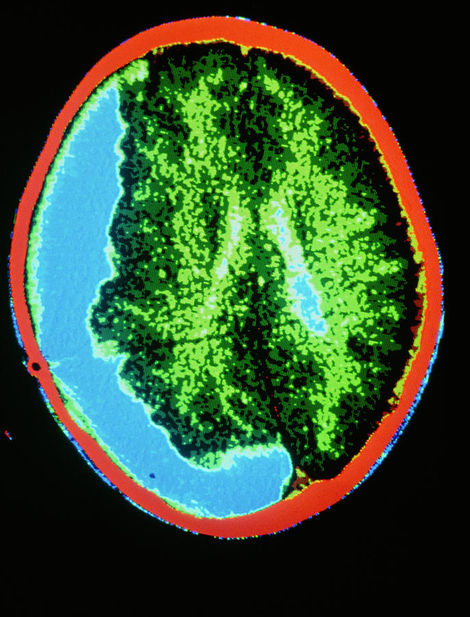 Coloured Mri Scan Of Big Pituitary Adenoma Tumour Photograph by Gca ...