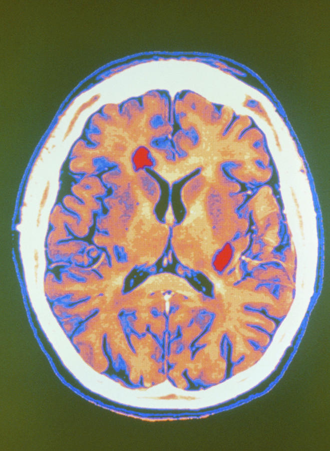 Coloured Mri Scan Of Brain In Multiple Sclerosis By Gcascience Photo Library 3844