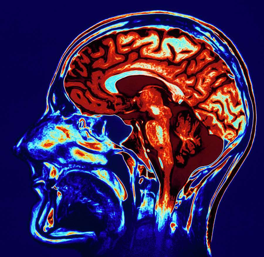 Coloured Mri Scan Of Brain In Sagittal Se Photograph by Geoff Tompkinson