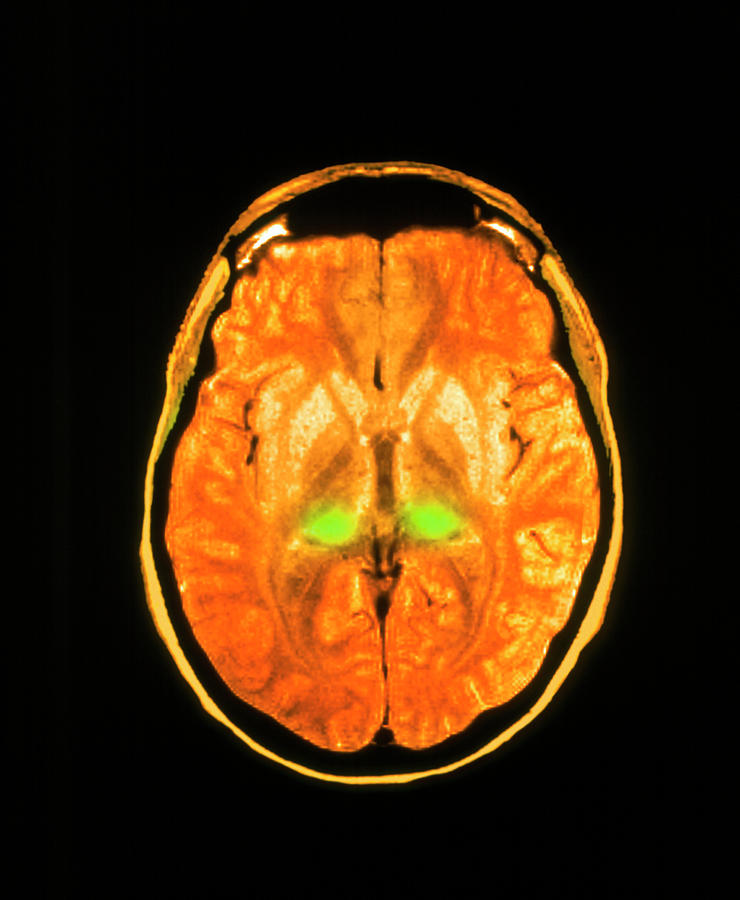 Coloured Mri Scan Of Human Brain Diseased With Cjd Photograph by Simon ...