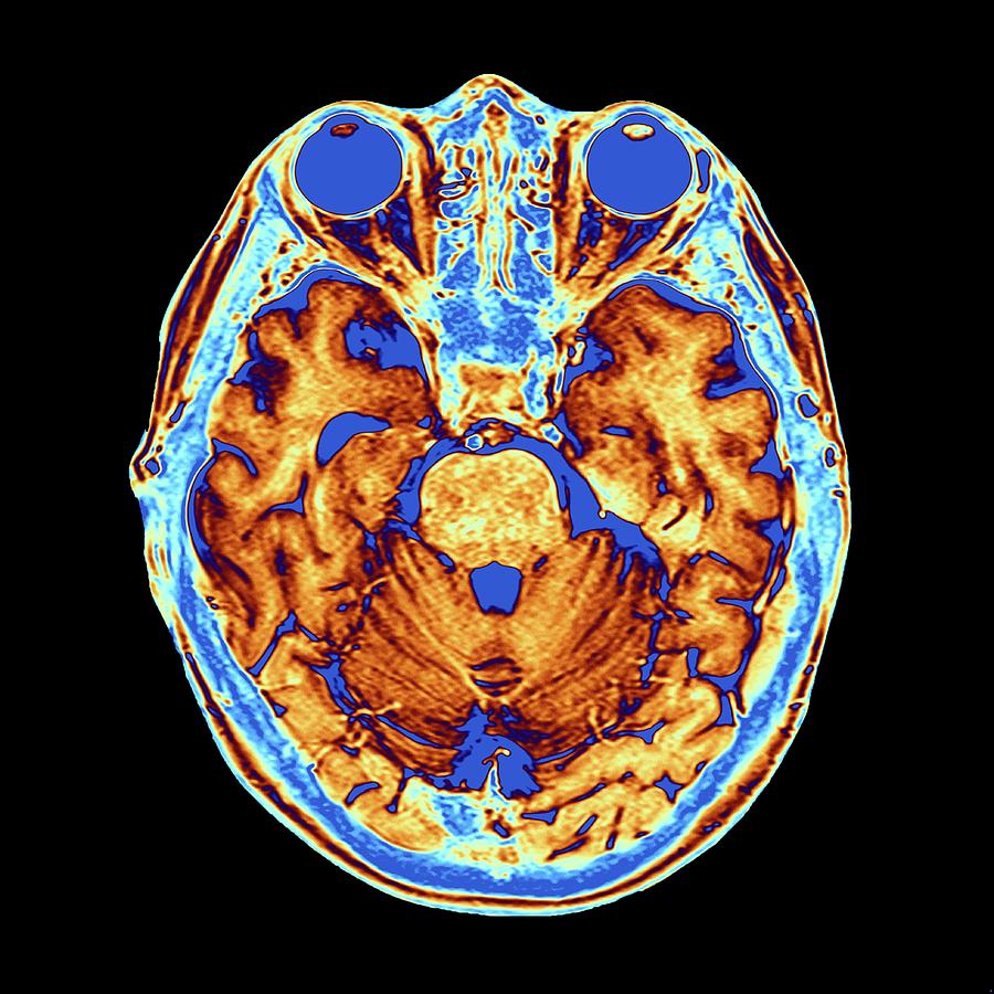 Coloured Mri Scan Of The Human Head Photograph by Alfred Pasieka/science Photo Library