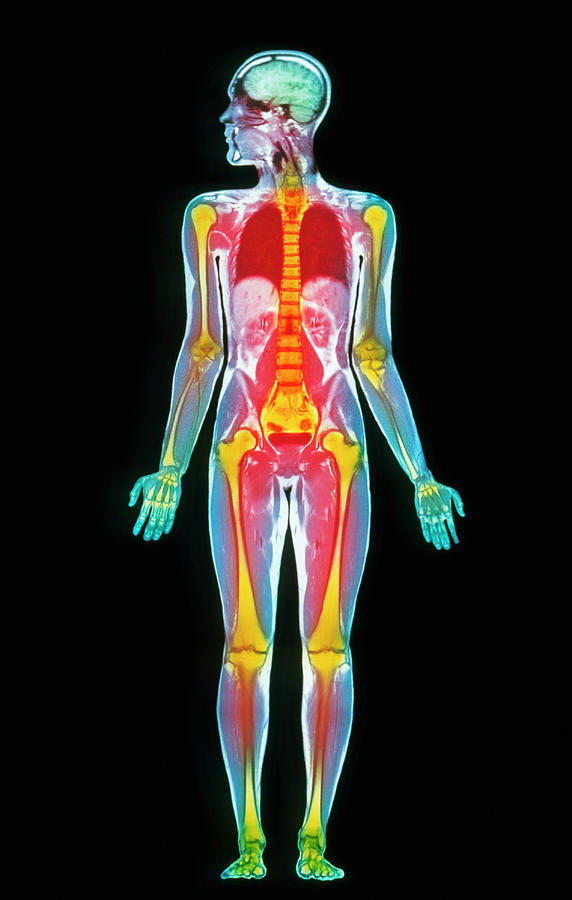 Coloured Mri Whole Body Scan Of A Man Photograph by Simon Fraser/science Photo Library