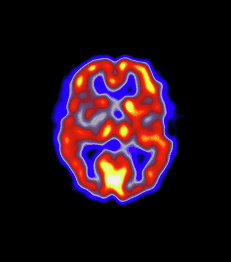 Coloured Pet Scan Of The Brain Of A Stroke Patient Photograph by Dept. Of Nuclear Medicine, Charing Cross Hospital/science Photo Library