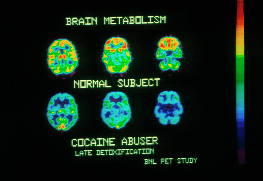 Coloured Pet Scans Of An Ex-cocaine Users Brain Photograph by Pascal Goetgheluck/science Photo Library