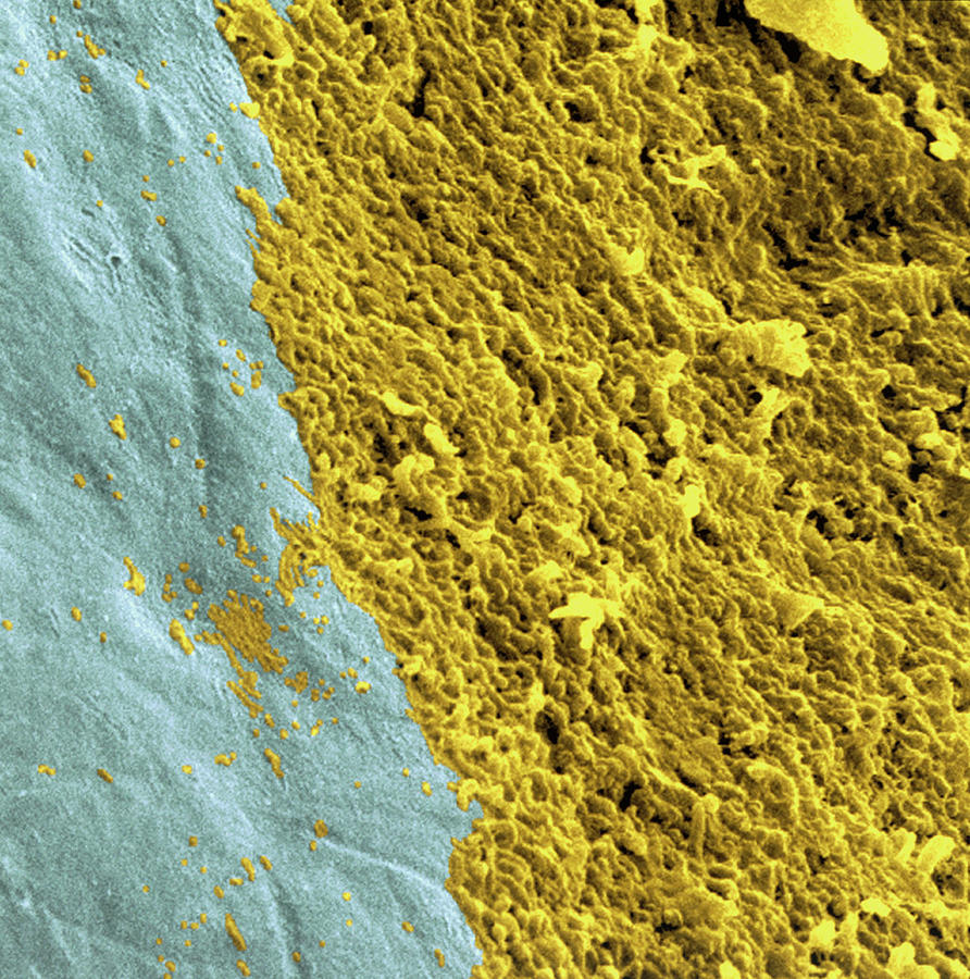Coloured Sem Of A Dental Plaque Seen On A Tooth Photograph by Dr Tony Brain/science Photo Library