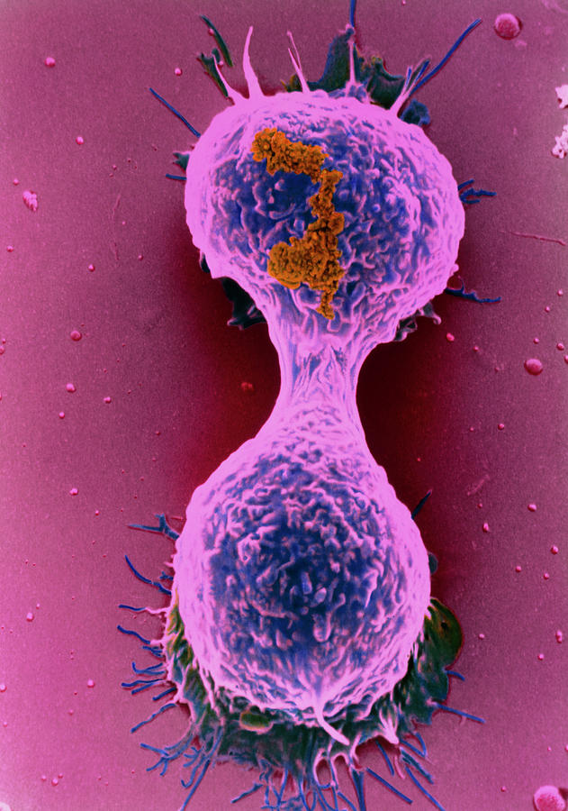 Coloured Sem Of A Dividing Breast Cancer Cell Photograph By Steve Gschmeissnerscience Photo