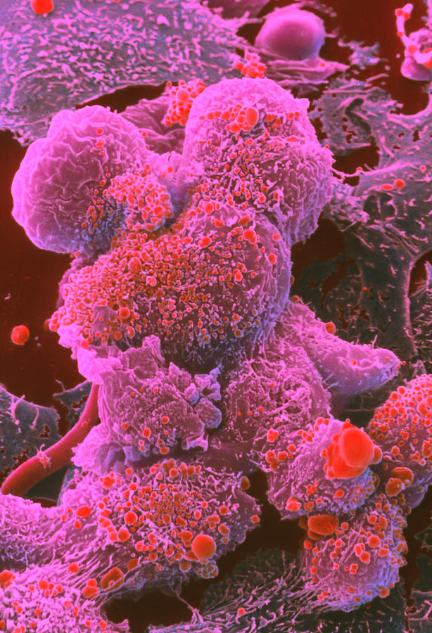 Coloured Sem Of Breast Cancer Cells Photograph By Steve Gschmeissnerscience Photo Library 3167