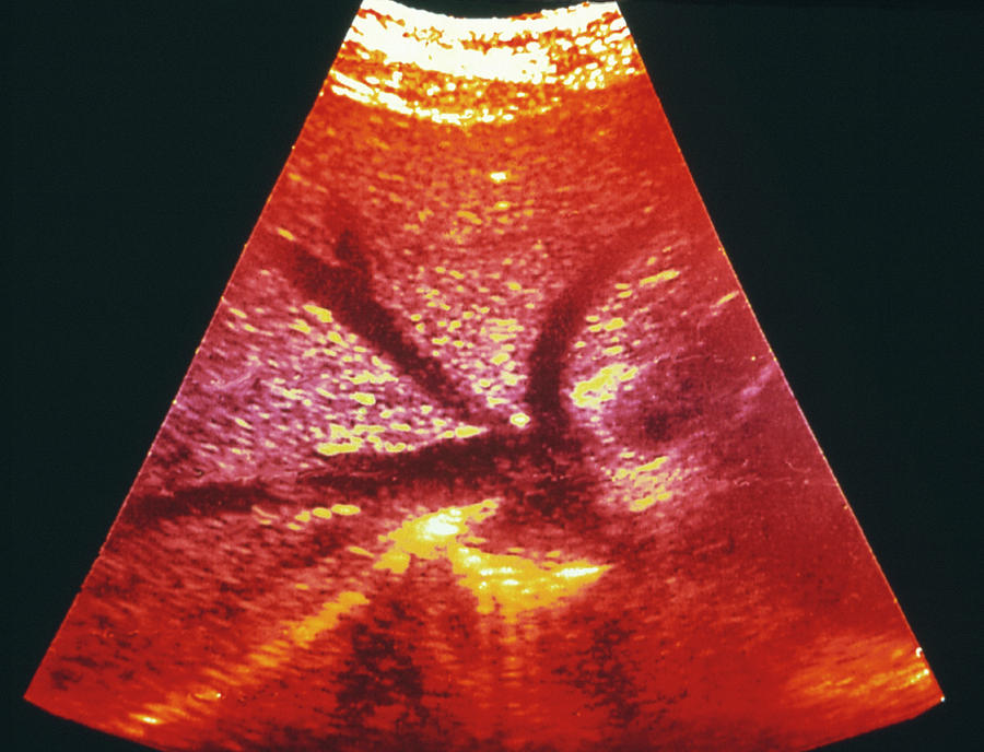 Liver Photograph - Coloured Ultrasound Of Livers Hepatic Arteries by Gjlp/science Photo Library