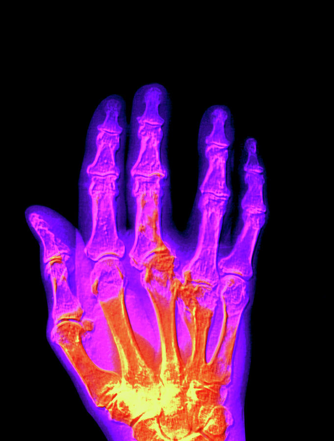 Coloured X-ray Of A Gout Sufferers Hand Photograph by Alfred Pasieka/science Photo Library