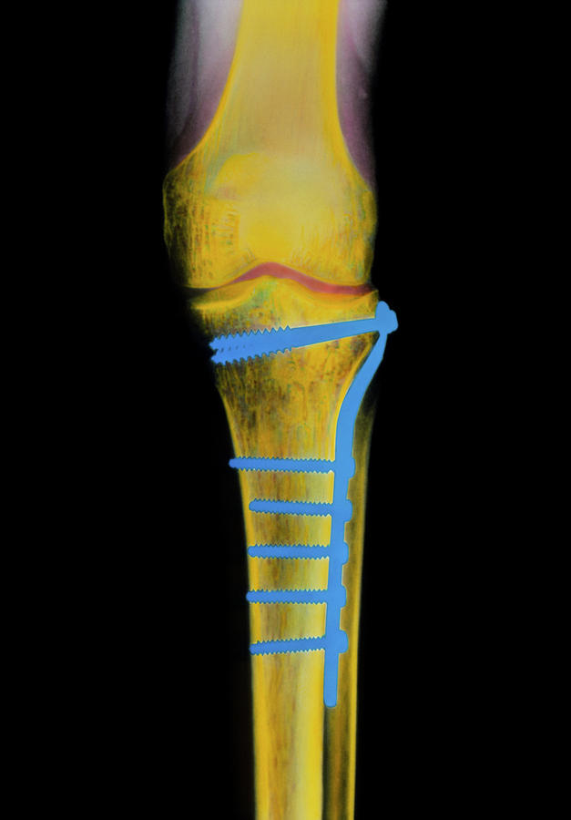 Coloured X-ray Of A Pinned Tibia (lower Leg Bone) Photograph by Science Photo Library