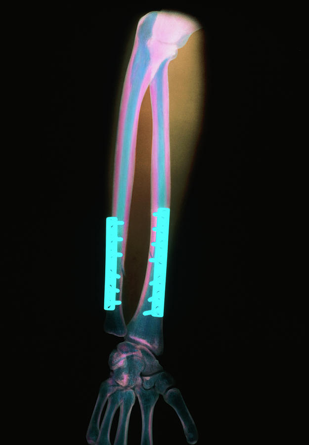 Coloured X Ray Of Arm Fracture Set With Steel Pins Photograph By Science Photo Library Pixels 2315