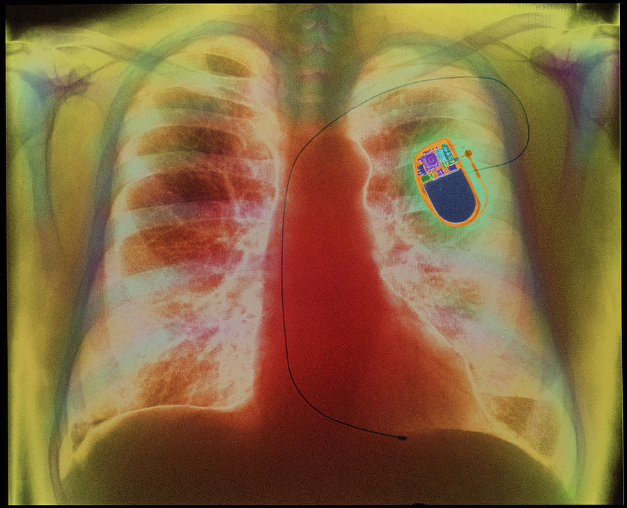 Coloured X-ray Of Chest Showing Heart Pac Photograph by Science Photo ...