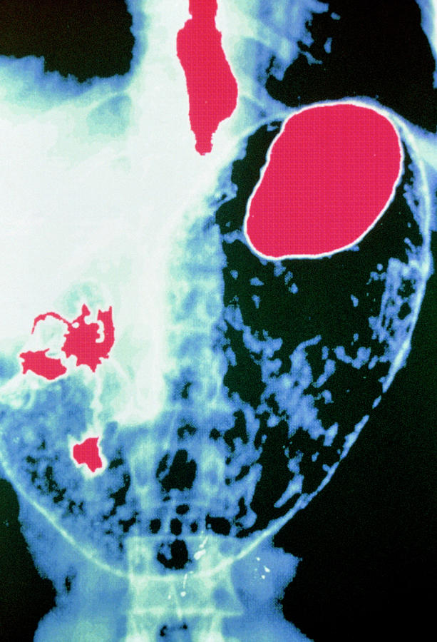 Coloured X-ray Of Dyspepsia In The Stomach Photograph by Gca/science ...