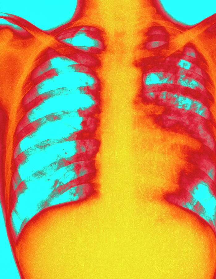 Coloured X-ray Of Human Chest Showing Pulmonary Tb Photograph by Science Photo Library