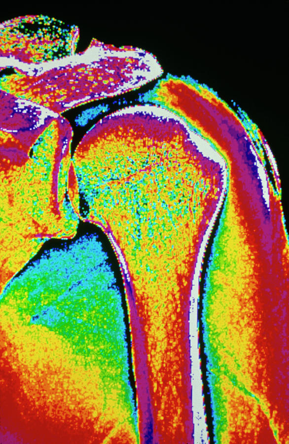 Coloured X-ray Of Human Shoulder Joint Photograph by Gca/science Photo Library