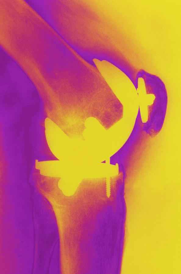 Coloured X Ray Of Prosthetic Knee Joint Photograph By Medical Photo Nhs Lothianscience Photo 5389