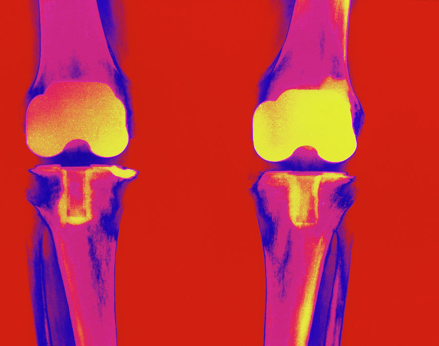 Coloured X-ray Of Prosthetic Knee Joints Photograph By Medical Photo ...